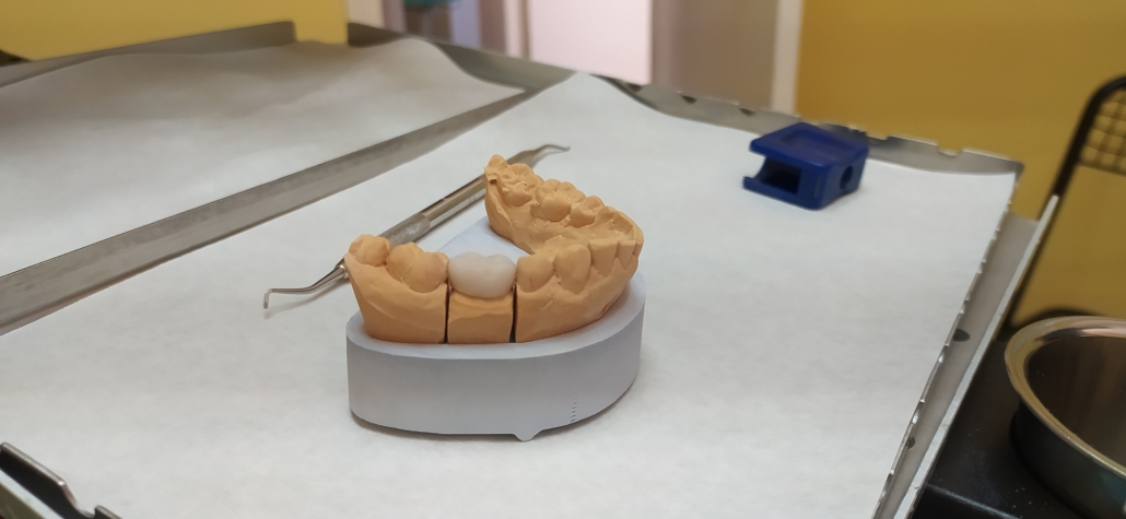 A test crown at a dentist in Nerja